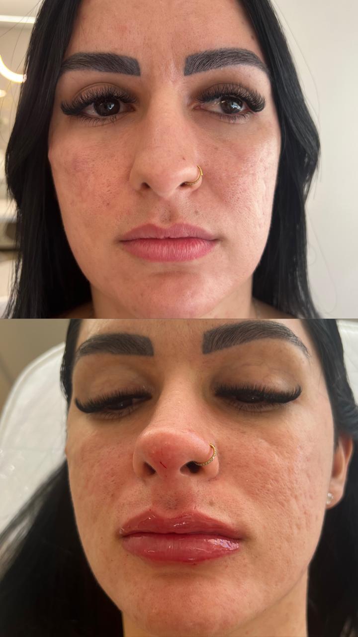 Preenchimento Labial